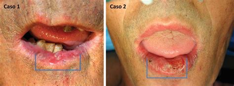 1 st Case: squamous cell carcinoma of the lower lip. 2 nd Case ...