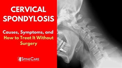 Cervical Spondylosis