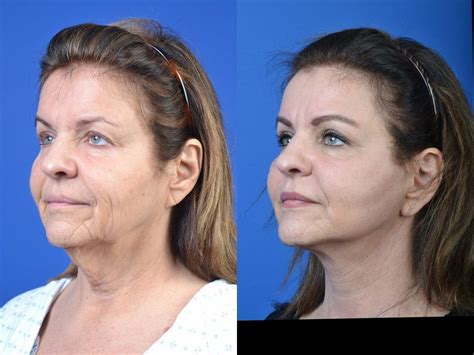 Facial Rejuvenation Procedures: FaceTite™ vs. Facelift - Grossman ...