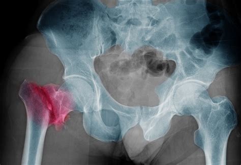 Bisphosphonates and Hip Fracture in People With Osteoporosis or ...