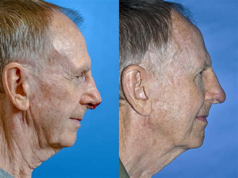 Mohs Surgery and Skin Cancer Photos | Melbourne, FL | Patient 58393