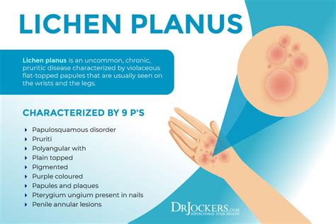 Lichen Planus: Symptoms, Causes & Support Strategies | Lichen planus ...