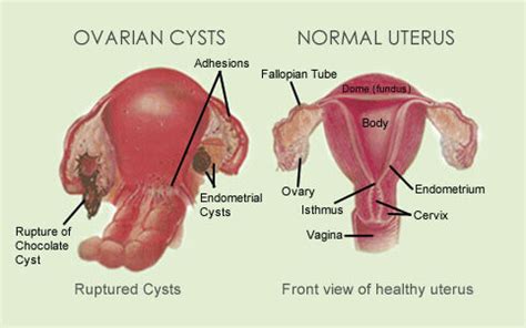 Endometriosis Surgery & Treatment Singapore - GynaeMD Women's & Rejuvenation Clinic