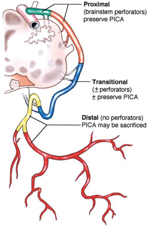 Posterior Inferior Cerebellar Artery Syndrome