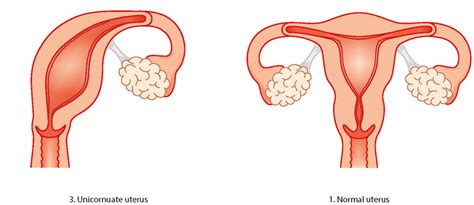 Uterine abnormality - problems with the womb | Tommy's