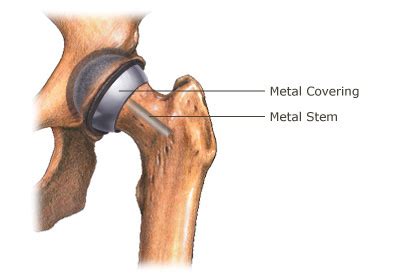 Total Hip Replacement Surgery - Quick Recovery