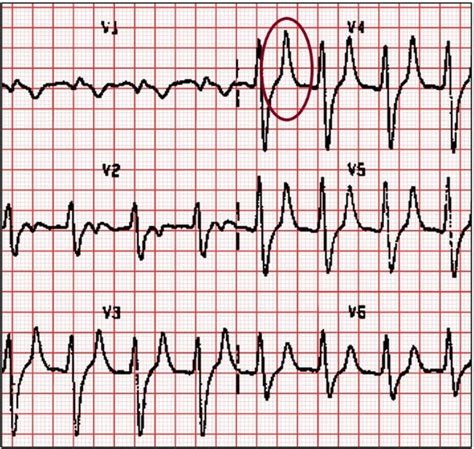 Hyperkalemia ECG Changes Mnemonic [With ECG Strips]