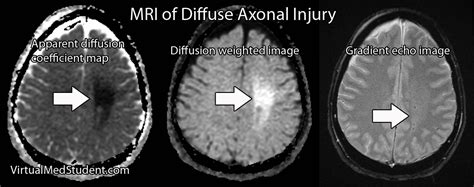 VirtualMedStudent.com || Diffuse Axonal Injury