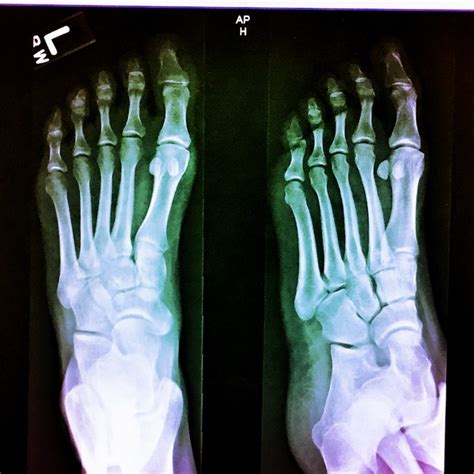 My Partial Plantar Plate Tear Injury: The Full Scoop – Joyful Miles