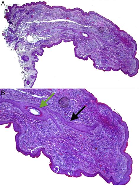 (A) Histopathology of the papule located on the columella. Hematoxylin... | Download Scientific ...