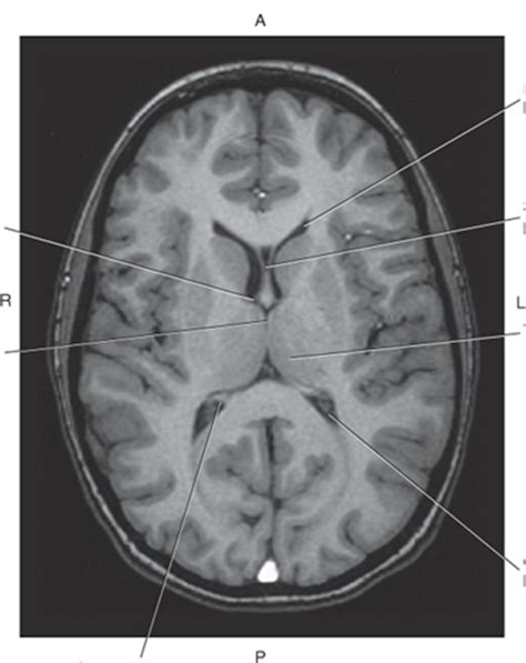 Lateral Ventricle MRI