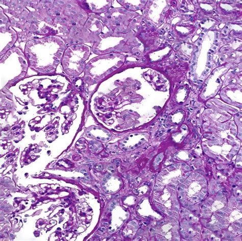 [Figure, Kidney biopsy showing glomeruli in Alport syndrome. Contributed by Rian Kabir, MD ...