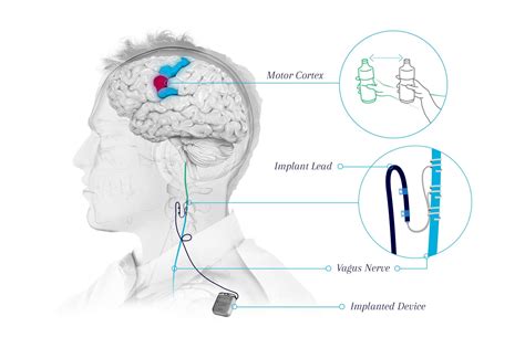 Vagus Nerve Stimulation Side Effects