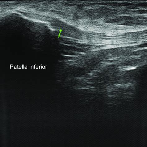 Glasgow Ultrasound Enthesitis Scoring System. | Download Table