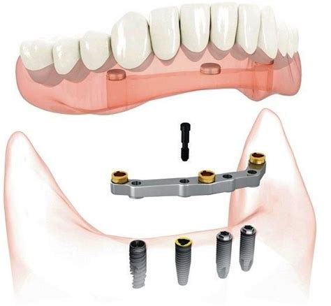 Metal bar supported denture with immediate loading 4 dental Implant ahmedabad india : Famous ...