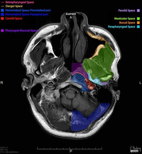 Deep spaces of the head and neck | Radiology Reference Article | Radiopaedia.org | Head and neck ...