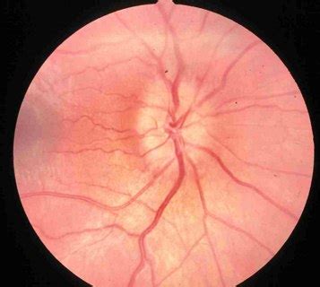 Papilledema - Definition, Pictures, Causes, Symptoms, Treatment