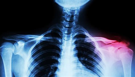 Clavicle Fractures | Johns Hopkins Medicine