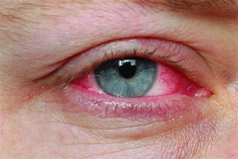 Pink eye, conjunctivitis, causes, symptoms, diagnosis & pink eye treatment