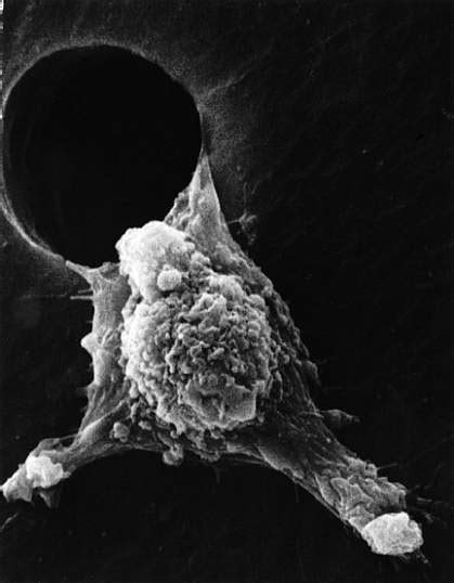 Rethinking Metastasis | National Institutes of Health (NIH)