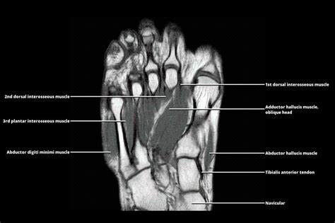 MRI - FOOT