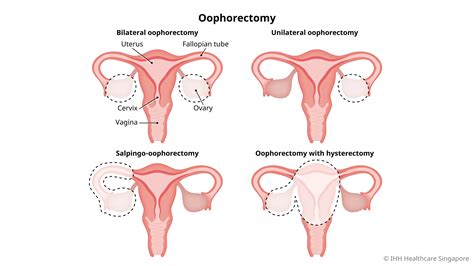 Oophorectomy (Ovary Removal Surgery) | Parkway Shenton