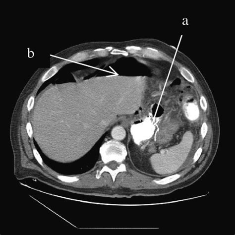 Case 2: gastrojejunal anastomosis with contrast extravasation (a) and ...