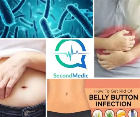 Belly Button Infections: Causes, Prevention, Symptoms & Treatment