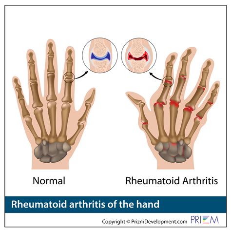 Hand Anatomy | University Orthopedics