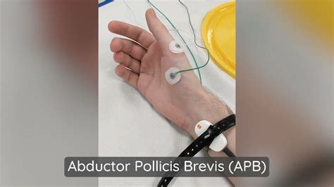 Abductor Pollicis Brevis (APB) Muscle Stimulation | Neurophysiology ...