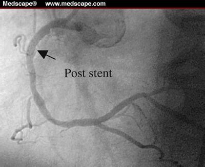 Coronary Artery: Right Coronary Artery Stent