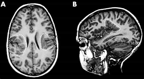 Polymicrogyria causes, symptoms, diagnosis, treatment & prognosis