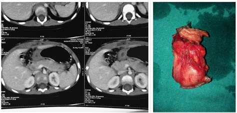 Gastro surgeon Liver Pancreas Gall Bladder Spleen Colorectal ...