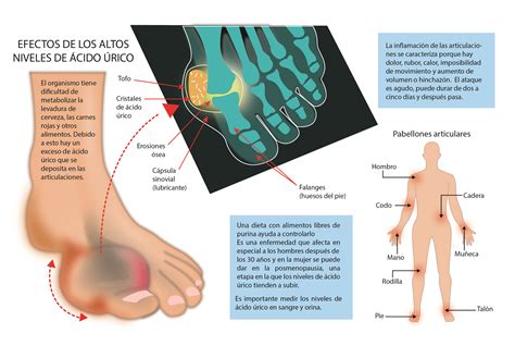 Opiniones de Ácido úrico