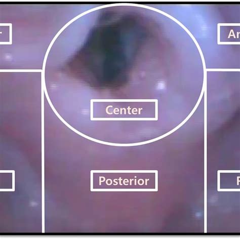 Five sections of the space around the laryngeal inlet. | Download Scientific Diagram