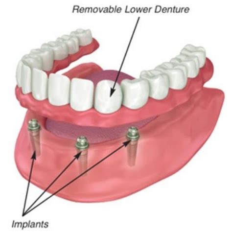 #1 Affordable Dentures Near Me & Partial -- Buffalo NY Stellar Dental