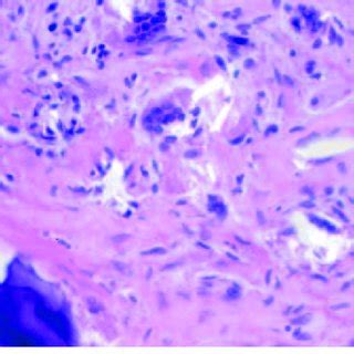 Photomicrograph showing inflammation of the joint capsule with... | Download Scientific Diagram