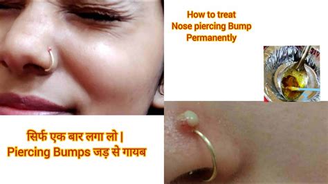 How to remove nose piercing bumps /Home remedies to remove bump / Get ...