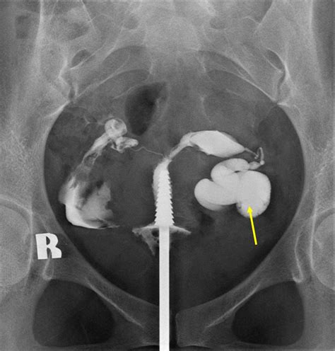 Hydrosalpinx – Radiology Cases