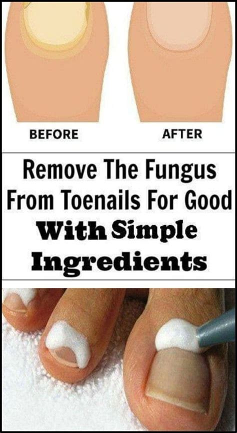 Here Are The 9 Ways To Remove The Fungus From Toenails For Good With Simple Ingre… | Toenail ...