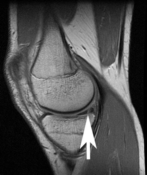 Arthroscopic Meniscus Repair | UW Orthopaedics and Sports Medicine, Seattle