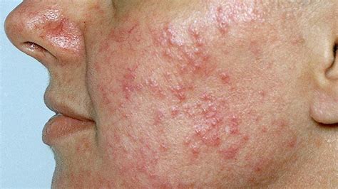 Acne Rosacea Vs Lupus Rash - Lupus Misdiagnosis Diseases That Can Mimic ...