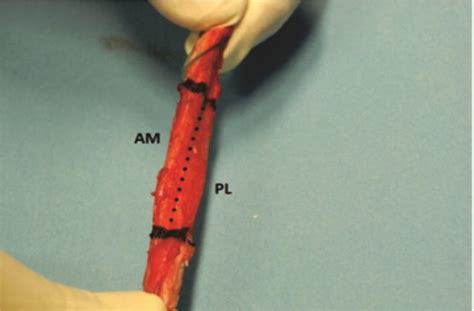 ACL Treatment in 2016 – Controversy and Consensus | Asian Journal of Arthroscopy