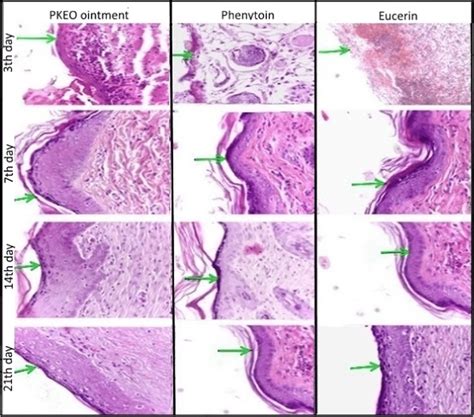 Epithelization process in wound location after treatment with PKEOs ...