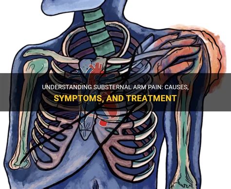 Understanding Substernal Arm Pain: Causes, Symptoms, And Treatment ...