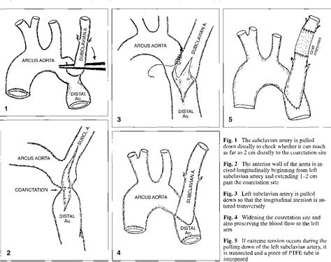 Figure 2 from Early and moderate long-term results of a new surgical ...