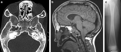 Craniodiaphyseal Dysplasia Skull