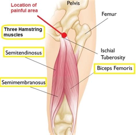 ISCHIAL BURSITIS - The Orthobiologic Clinic