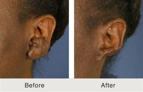 Keloid Scarring: What Is It and How Is It Fixed? - Carolina Facial Plastics