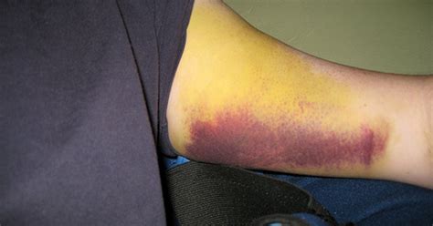 Bone bruise treatment | eHow UK